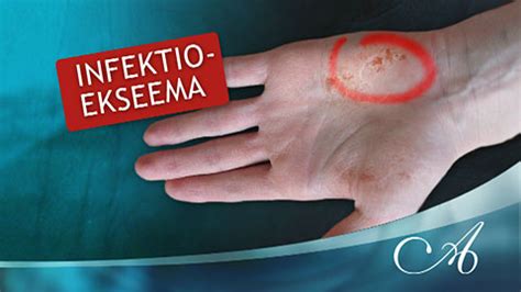 infektioekseema