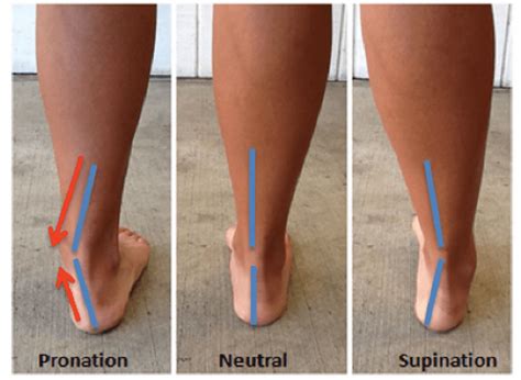 overpronation